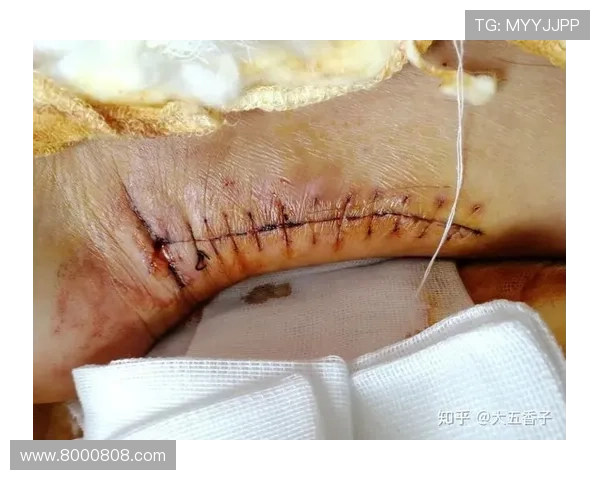 阿圭罗老将赛跟腱断裂或手术